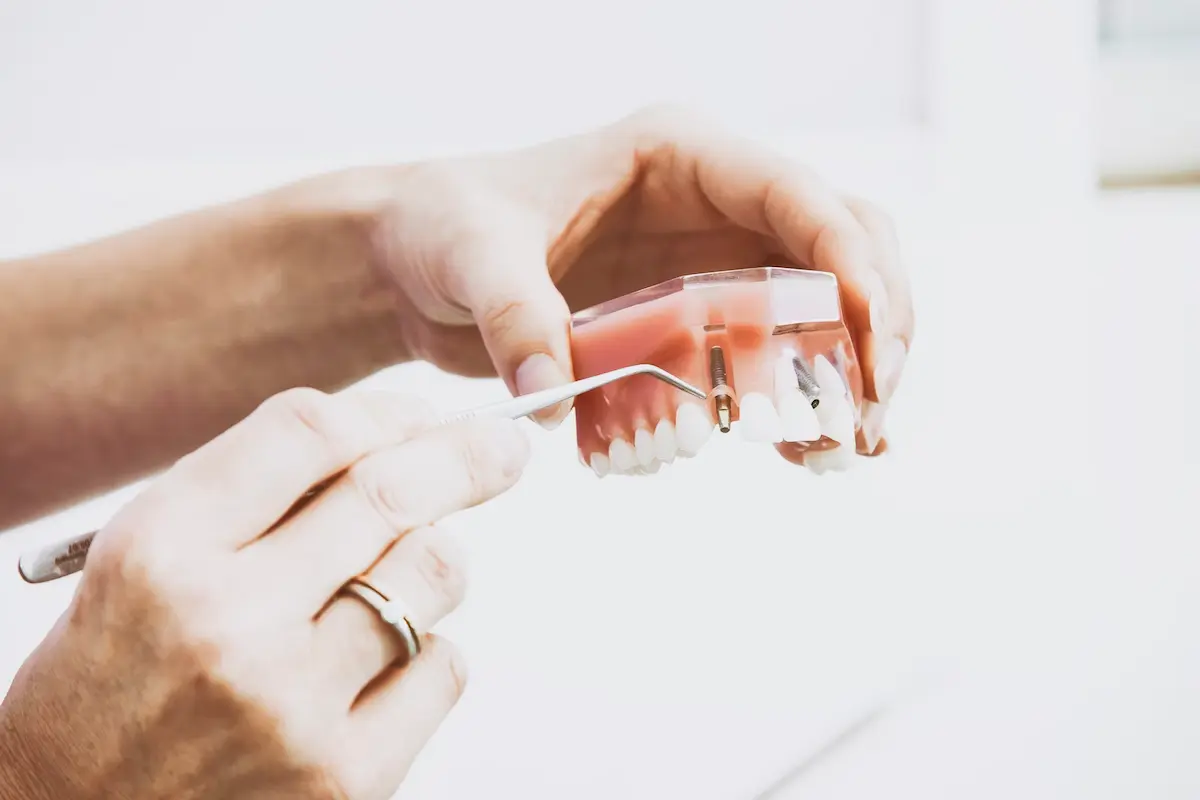 importancia-implantes-dentales-salud-bucal